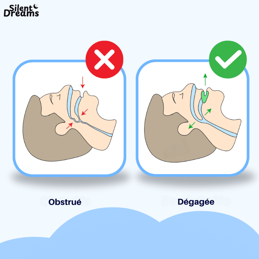 Silent Pro - Dispositif Anti-Ronflement en Silicone