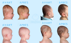 Oreiller pour bébé corrigeant et prévenant la plagiocéphalie (Anti Tête Plate) - TÊTE RONDE